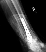 Periarticular locking plate
